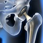 Hip Implant